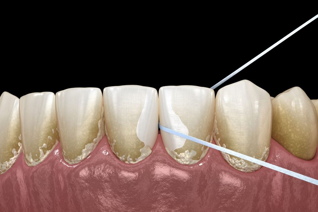 Zahnbelag ist eine dünne Schicht einer klebrigen Substanz, die meist aus einer Mischung aus Speichel, Bakterien und anderen Mikroorganismen wie Pilzen besteht und sich am Zahnfleischrand, zwischen den Zähnen und auch auf der Vorderseite und hinter den Zähnen ablagert.