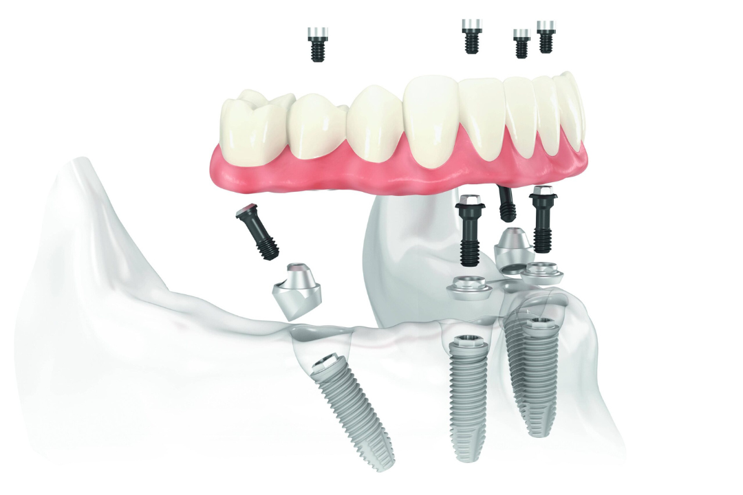 All-on-4 dental implant