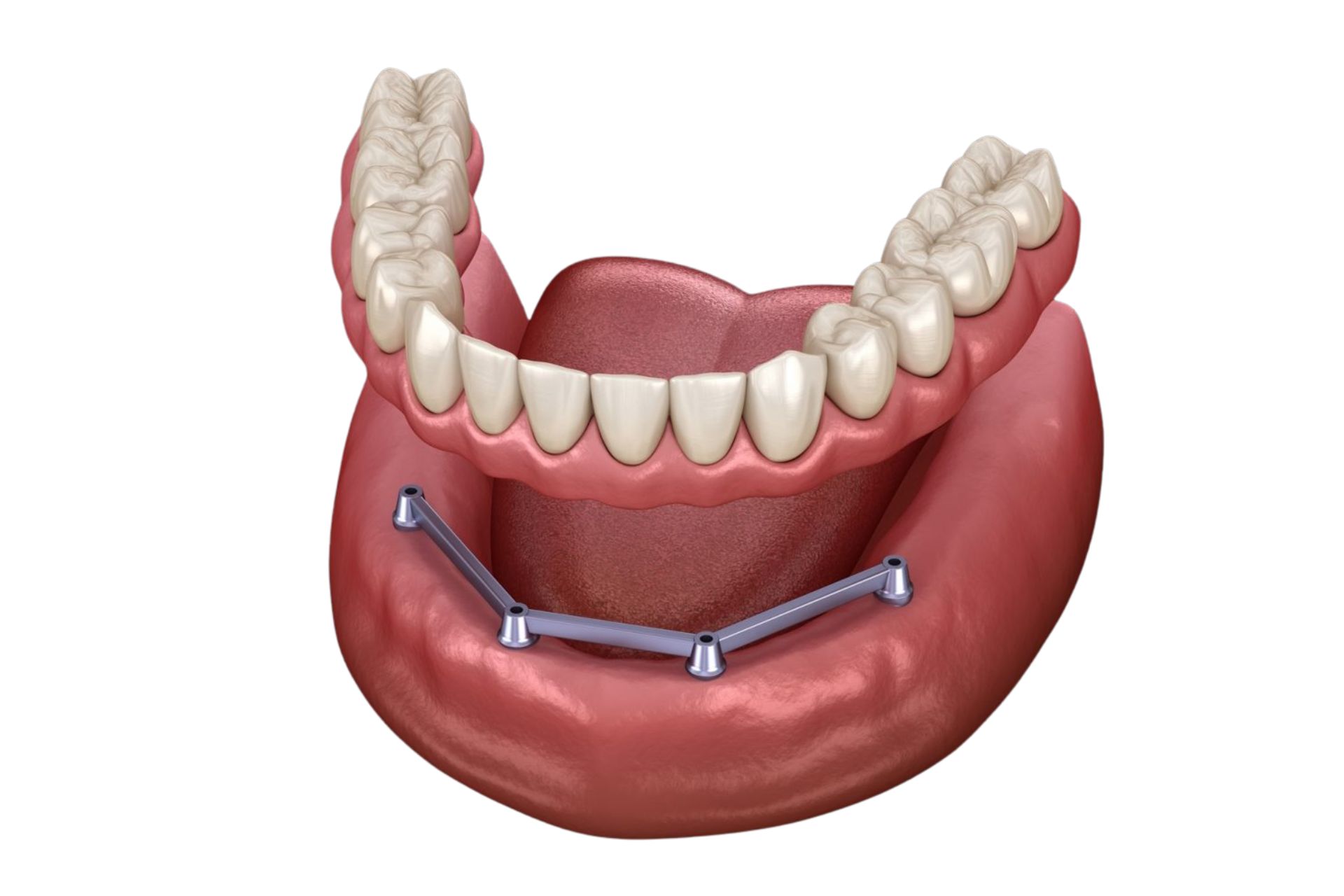 Stegprothese