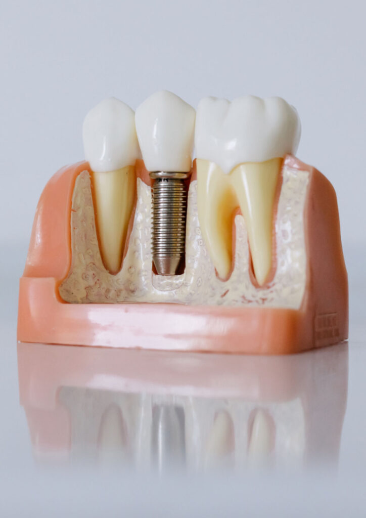 zahnimplantat