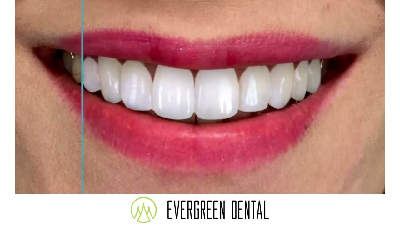 Digitales Lächeln Design -Evergreen Dental