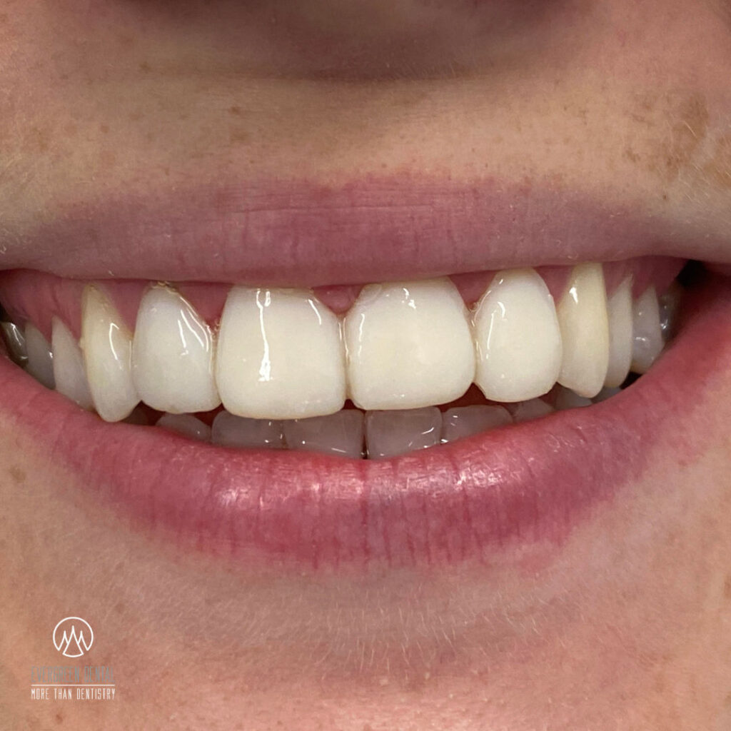 Express Zahnkronen und Brücken