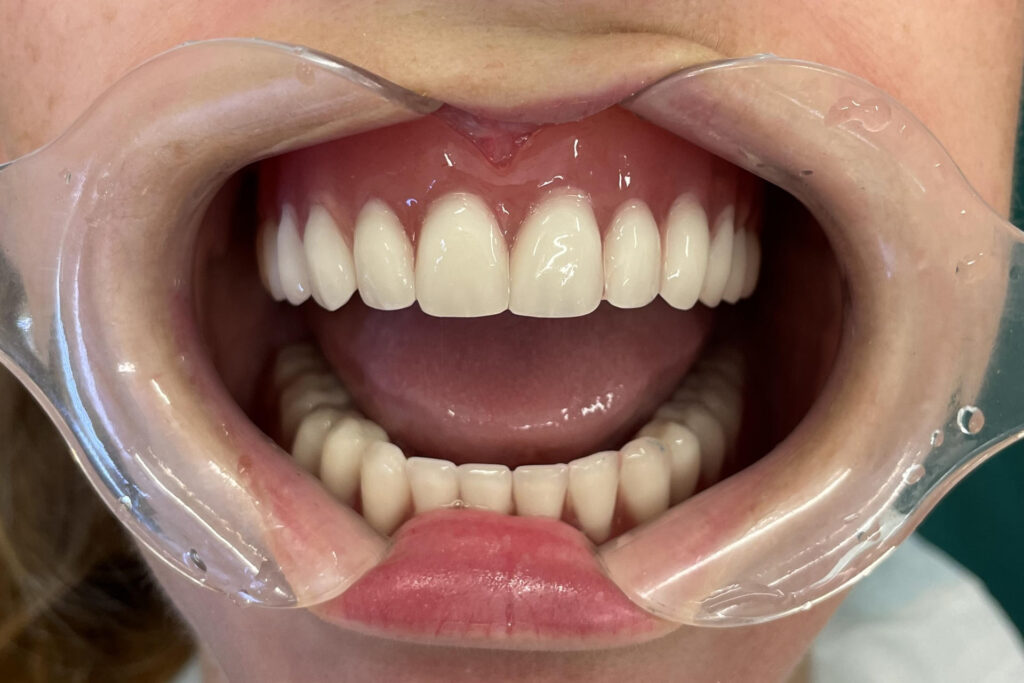 Stegprothese auf 4 Implantaten